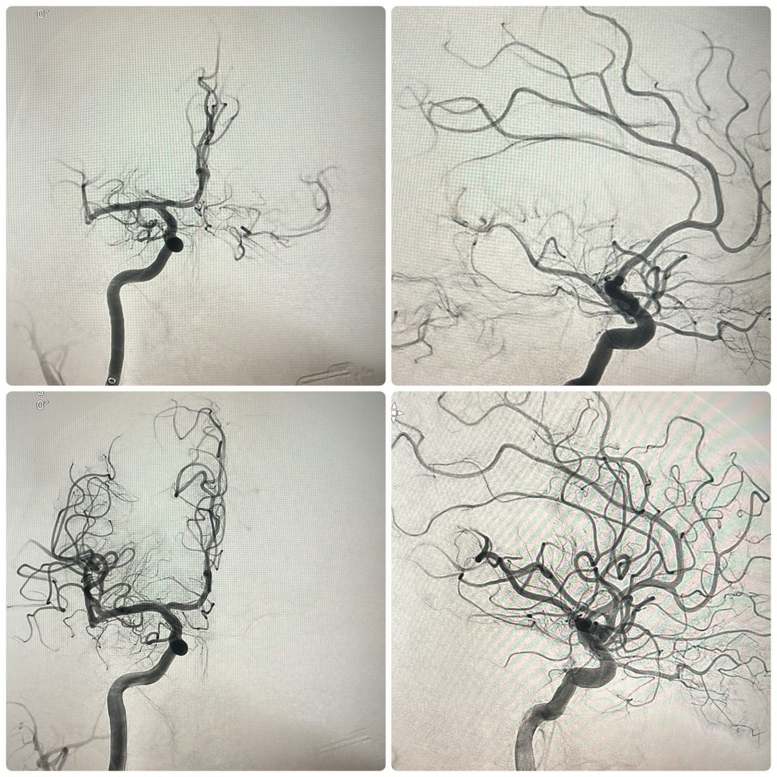 Жасанды интеллект дәрігерлерге инсульт кезінде адам өмірін құтқаруға көмектеседі